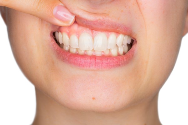 Are There Any At Home Methods For Treating Receding Gums?