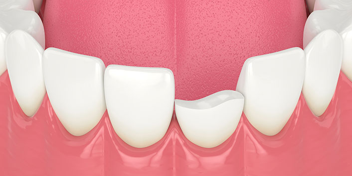 Why It Is Important to Repair a Chipped Tooth - Sandston